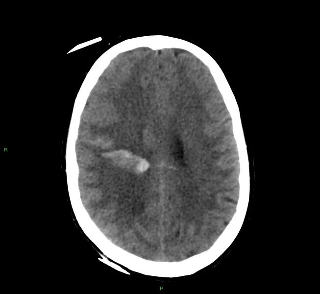 File:Cerebral amyloid angiopathy-associated lobar intracerebral hemorrhage (Radiopaedia 58566-65730 Axial non-contrast 20).jpg