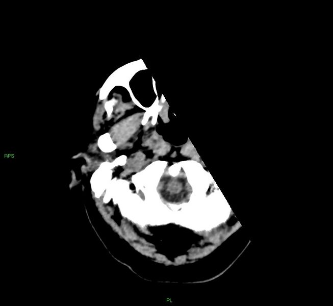File:Cerebral amyloid angiopathy-associated lobar intracerebral hemorrhage (Radiopaedia 58569-65734 Axial non-contrast 53).jpg