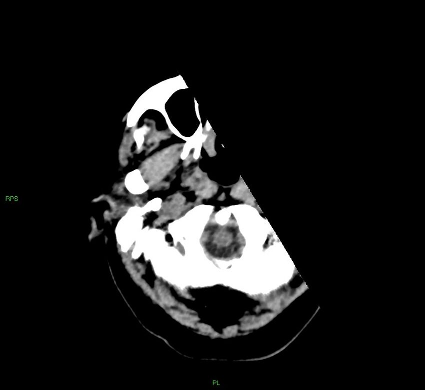 Cerebral amyloid angiopathy-associated lobar intracerebral hemorrhage (Radiopaedia 58569-65734 Axial non-contrast 53).jpg