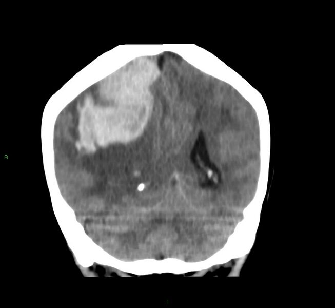 File:Cerebral amyloid angiopathy-associated lobar intracerebral hemorrhage (Radiopaedia 58751-65972 Coronal non-contrast 22).jpg