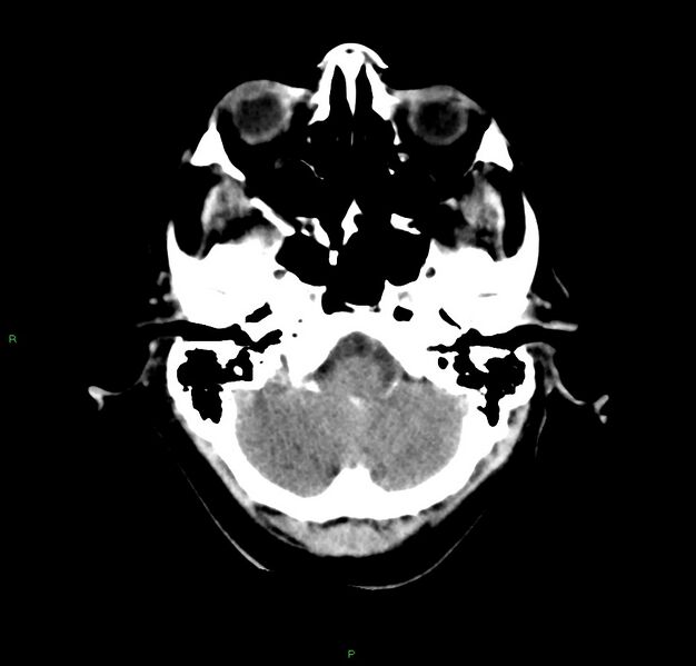 File:Cerebral amyloid angiopathy-associated lobar intracerebral hemorrhage (Radiopaedia 59356-66716 Axial non-contrast 40).jpg