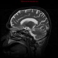 Cerebral and orbital tuberculomas (Radiopaedia 13308-13311 Sagittal T2 12).jpg