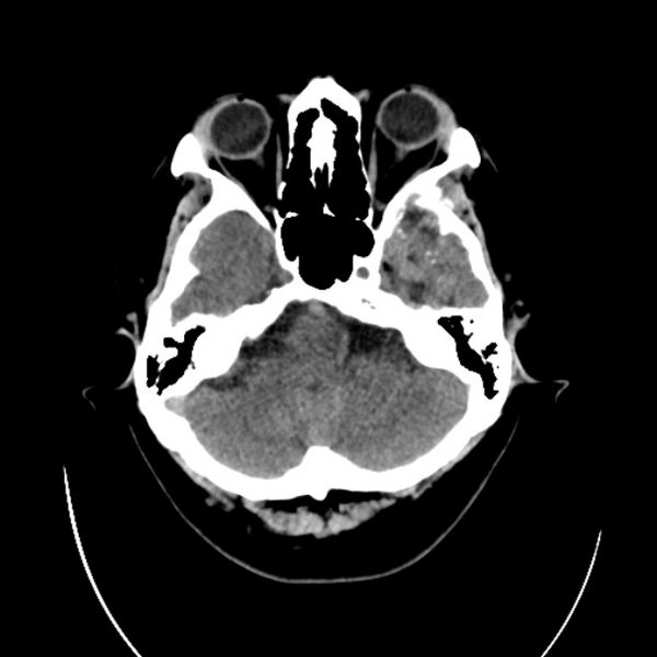 File:Cerebral arteriovenous malformation (Radiopaedia 43729-47189 Axial non-contrast 7).jpg