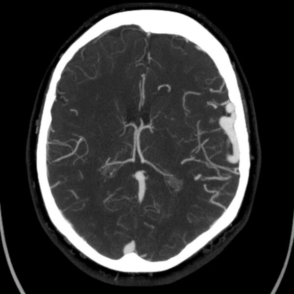 File:Cerebral arteriovenous malformation (Radiopaedia 43729-47189 B 28).jpg