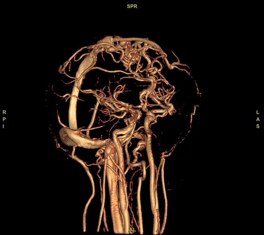 Cerebral arteriovenous malformation (Radiopaedia 61964-70029 VRT 34).jpg