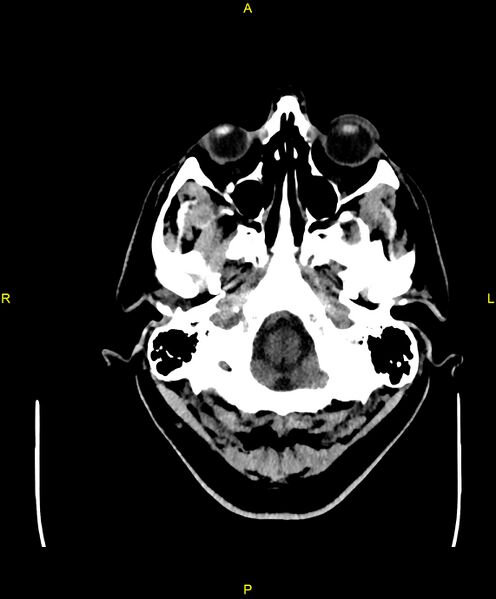 File:Cerebral autosomal dominant arteriopathy with subcortical infarcts and leukoencephalopathy (CADASIL) (Radiopaedia 86108-102051 Axial non-contrast 9).jpg