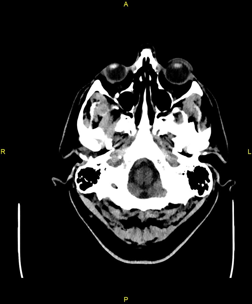 Cerebral autosomal dominant arteriopathy with subcortical infarcts and leukoencephalopathy (CADASIL) (Radiopaedia 86108-102051 Axial non-contrast 9).jpg