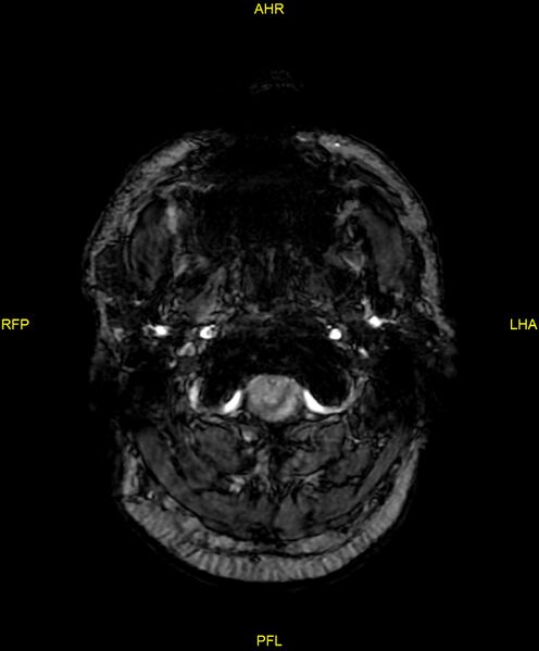 File:Cerebral autosomal dominant arteriopathy with subcortical infarcts and leukoencephalopathy (CADASIL) (Radiopaedia 86108-102054 Axial SWI 4).jpg