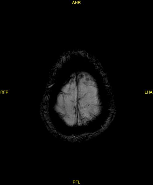 File:Cerebral autosomal dominant arteriopathy with subcortical infarcts and leukoencephalopathy (CADASIL) (Radiopaedia 86108-102054 Axial SWI 99).jpg