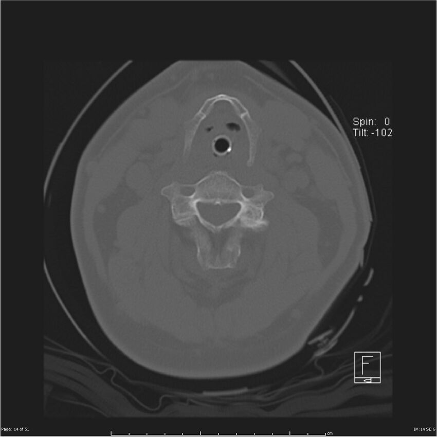 Cerebral hemorrhagic contusions and cervical spine fractures (Radiopaedia 32865-33841 C 14).jpg