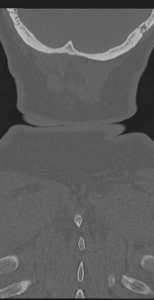 File:Cervical canal stenosis - OPLL and osteophytes (Radiopaedia 47329-51910 Coronal bone window 69).png