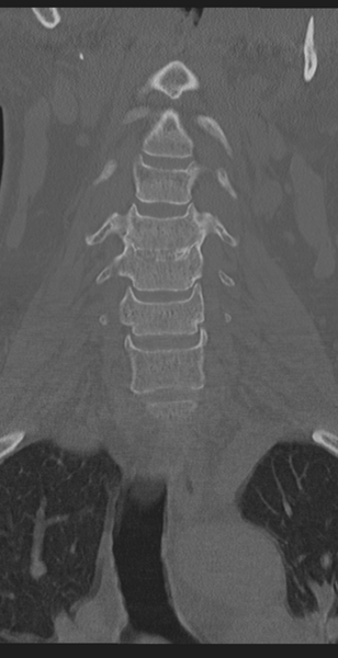 File:Cervical canal stenosis due to ossification of the posterior longitudinal ligament (Radiopaedia 47260-51823 Coronal bone window 17).png