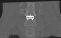 Cervical disc replacement (Radiopaedia 37383-39205 Coronal bone window 29).png
