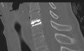 Cervical disc replacement (Radiopaedia 37383-39205 Sagittal bone window 41).png