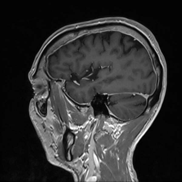File:Cervical dural CSF leak on MRI and CT treated by blood patch (Radiopaedia 49748-54995 G 94).jpg