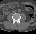 Cervical dural CSF leak on MRI and CT treated by blood patch (Radiopaedia 49748-54996 B 101).png