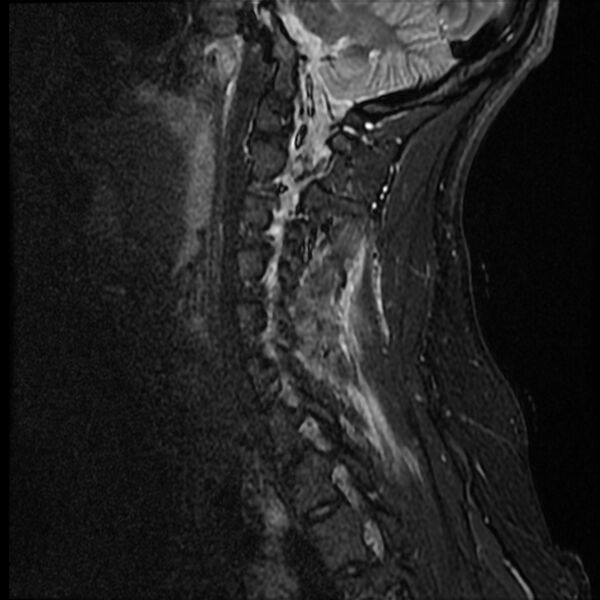 File:Cervical facet fracture and anterior discoligamentous injury (Radiopaedia 32139-33084 Sagittal STIR 12).jpg