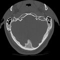 Cervical flexion teardrop fracture with cord hemorrhage (Radiopaedia 32497-33454 Axial bone window 6).jpg
