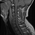 Cervical flexion teardrop fracture with cord hemorrhage (Radiopaedia 32497-33455 Sagittal T1 9).jpg