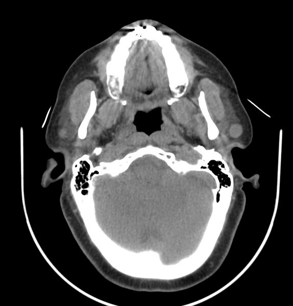 File:Cervical lymphadenopathy- cause unknown (Radiopaedia 22420-22457 non-contrast 36).jpg