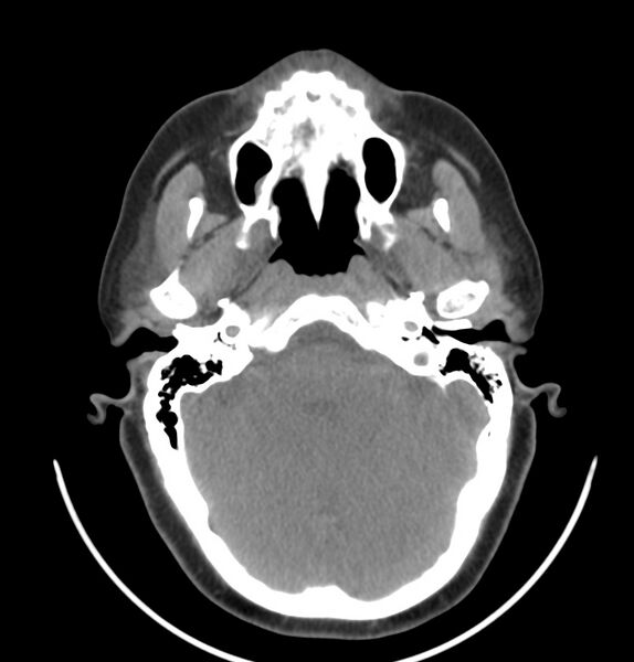 File:Cervical lymphadenopathy- cause unknown (Radiopaedia 22420-22457 non-contrast 38).jpg