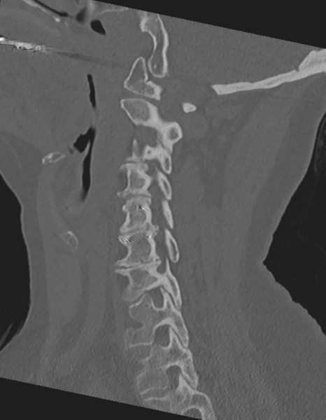 File:Cervical spine ACDF loosening (Radiopaedia 48998-54071 Sagittal bone window 35).png