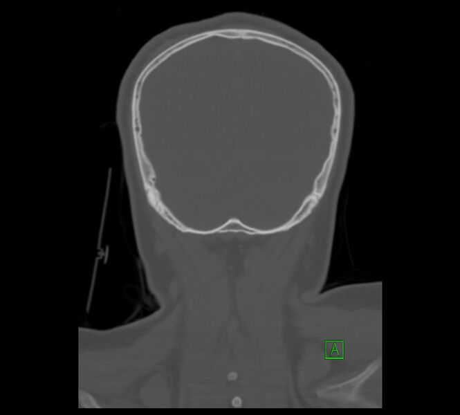 File:Cervical spine fracture - hyperflexion injury (Radiopaedia 66184-75364 Coronal bone window 21).jpg