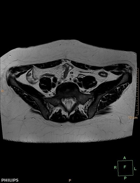 File:Cesarian scar endometriosis (Radiopaedia 68495-78066 Axial T2 1).jpg