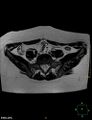 Cesarian scar endometriosis (Radiopaedia 68495-78066 Axial T2 1).jpg