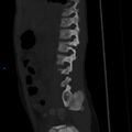 Chance fracture with duodenal and pancreatic lacerations (Radiopaedia 43477-50042 Sagittal bone window 4).jpg
