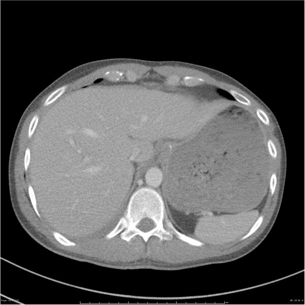 File:Chest and abdomen multi-trauma (Radiopaedia 26294-26426 A 18).jpg