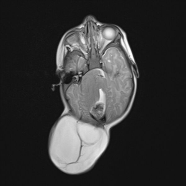 File:Chiari III malformation with occipital encephalocele (Radiopaedia 79446-92559 Axial T2 12).jpg