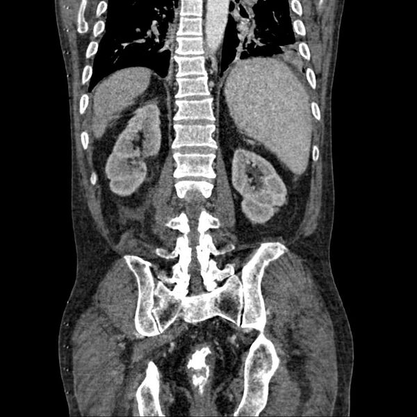 File:Cholangitis and abscess formation in a patient with cholangiocarcinoma (Radiopaedia 21194-21100 C 15).jpg