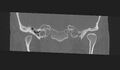 Cholesteatoma (Radiopaedia 10742-11203 Coronal bone window 2).jpg