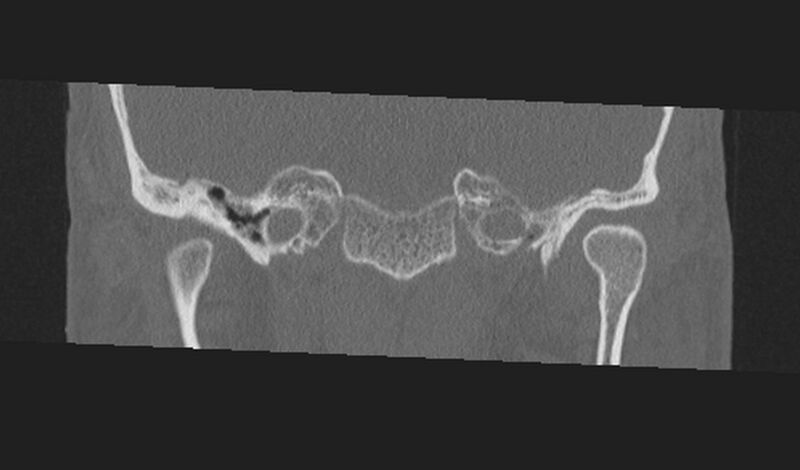 File:Cholesteatoma (Radiopaedia 10742-11203 Coronal bone window 2).jpg