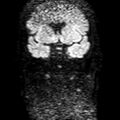 Cholesteatoma (Radiopaedia 10742-11204 Coronal DWI 2).jpg