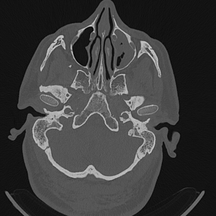 Cholesteatoma (Radiopaedia 68176-77673 Axial bone window 13).jpg