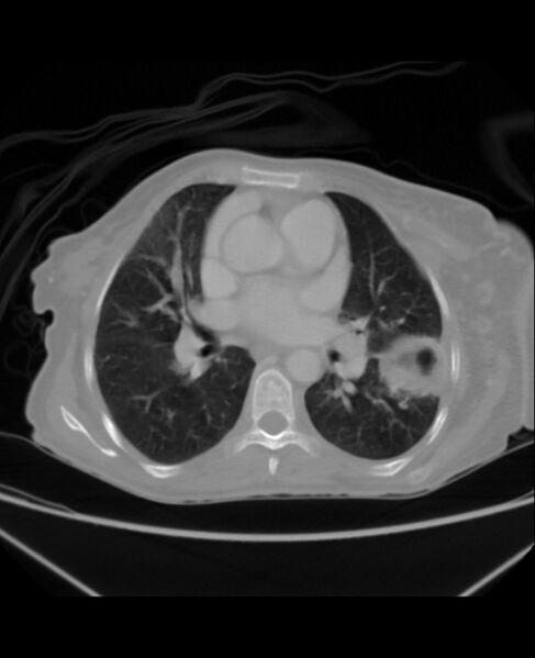 File:Chondrosarcoma (Radiopaedia 79427-92535 Axial lung window 27).jpg