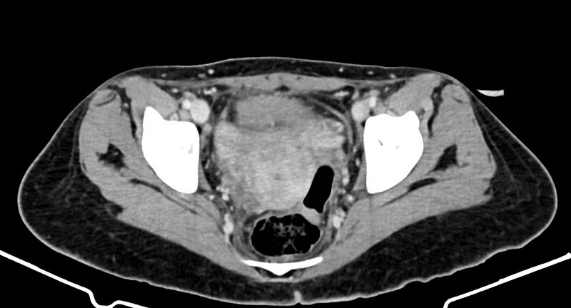 File:Choriocarcinoma liver metastases (Radiopaedia 74768-85766 A 184).jpg