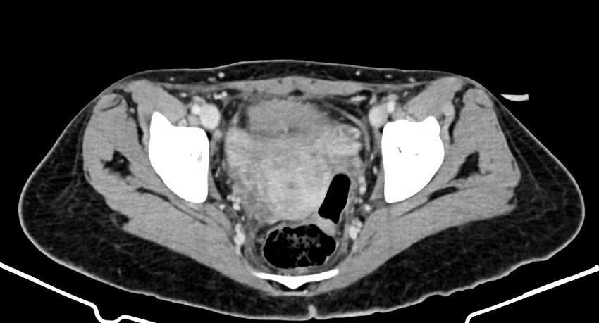 Choriocarcinoma liver metastases (Radiopaedia 74768-85766 A 184).jpg