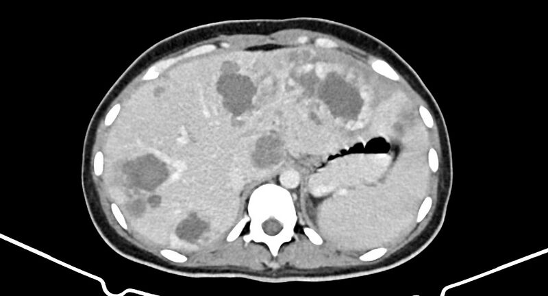 File:Choriocarcinoma liver metastases (Radiopaedia 74768-85766 A 54).jpg