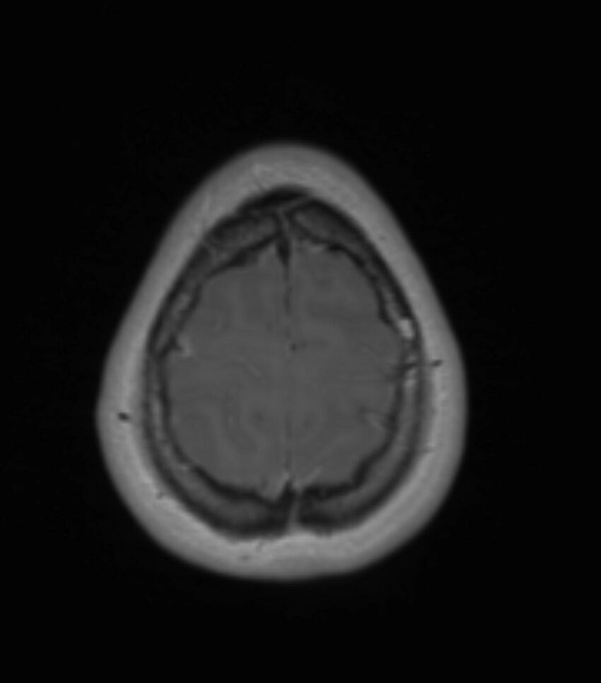 Choroid plexus carcinoma (Radiopaedia 91013-108553 Axial T1 C+ 193).jpg
