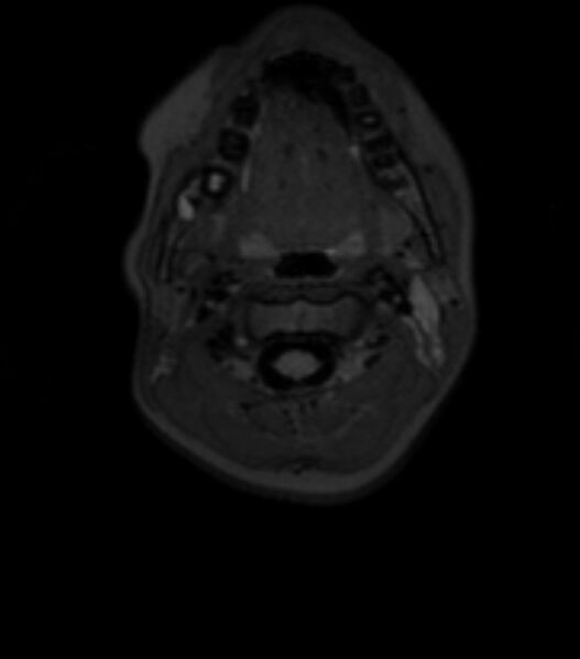 File:Choroid plexus carcinoma (Radiopaedia 91013-108553 Axial T2 fat sat 2).jpg