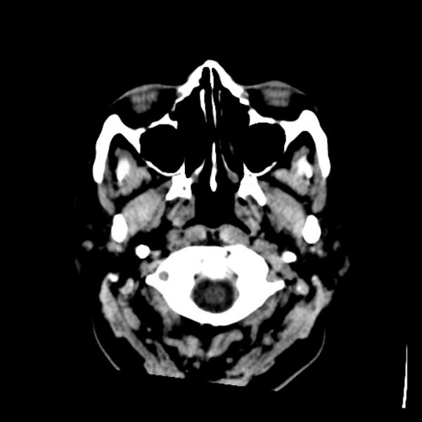 File:Chronic bilateral occipital lobe infarcts (Radiopaedia 31276-31996 Axial non-contrast 1).jpg