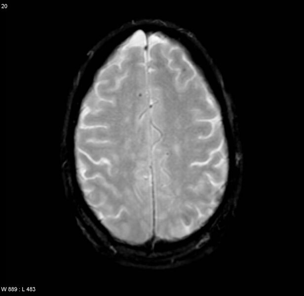 File:Chronic hypertensive encephalopathy (Radiopaedia 4564-6686 Axial Gradient Echo 14).jpg