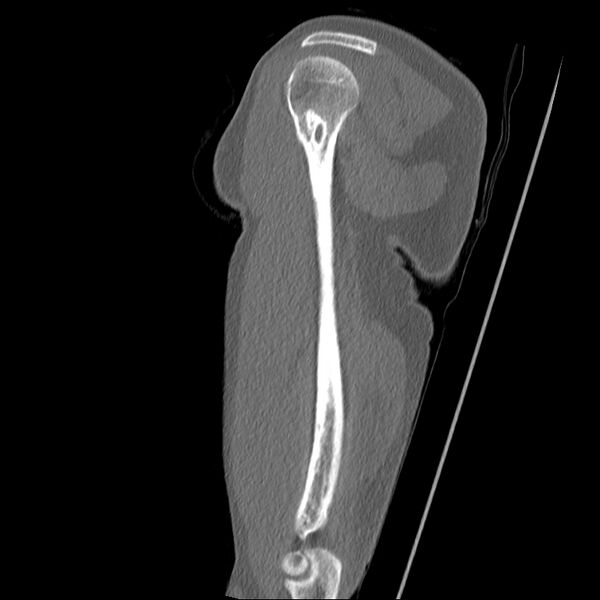 File:Chronic osteomyelitis (Radiopaedia 67597-76998 Sagittal bone window 11).jpg