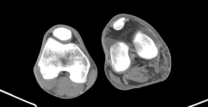 File:Chronic osteomyelitis (with sequestrum) (Radiopaedia 74813-85822 Axial 371).jpg