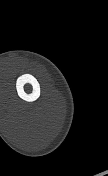 File:Chronic osteomyelitis of the distal humerus (Radiopaedia 78351-90971 Axial bone window 16).jpg