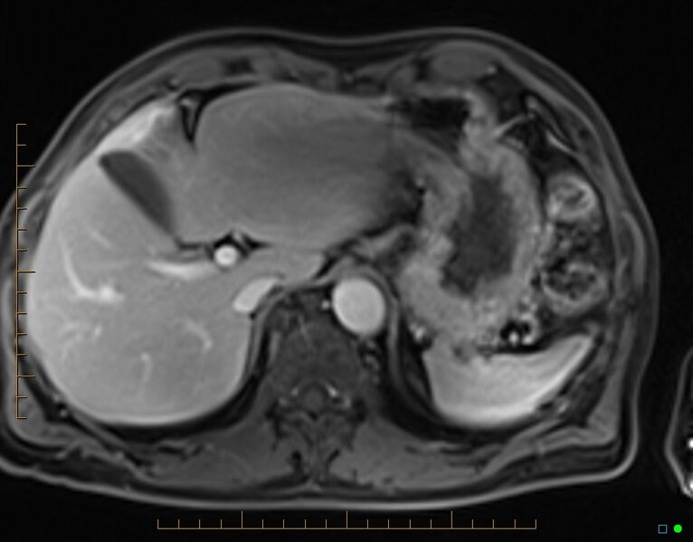 File:Chronic pancreatitis (Radiopaedia 17014-16716 Axial T1 C+ fat sat 14).jpg
