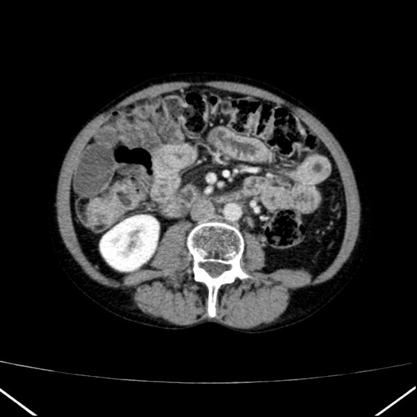 File:Chronic pancreatitis (Radiopaedia 23132-23172 B 32).jpg